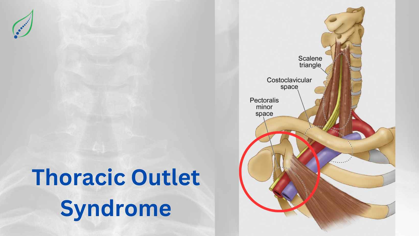 Thoracic Outlet Syndrome